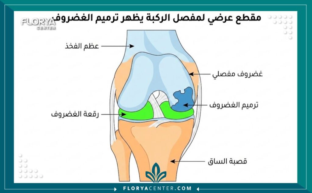 رسم توضيحي تشريحي لمفصل الركبة يوضح كيفية تثبيت الغضروف المزروع.