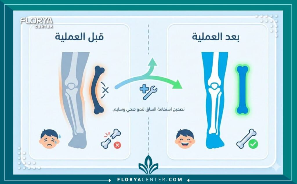 إنفوجرافيك يوضح نتائج عملية شق العظم التصحيحي للأطفال قبل وبعد التدخل الجراحي.