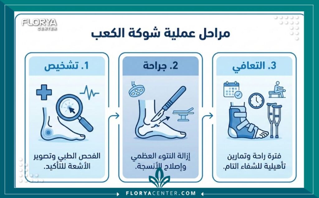 إنفوجرافيك يوضح مراحل علاج عملية علاج شوكة الكعب جراحياً وخطوات الاستشفاء.