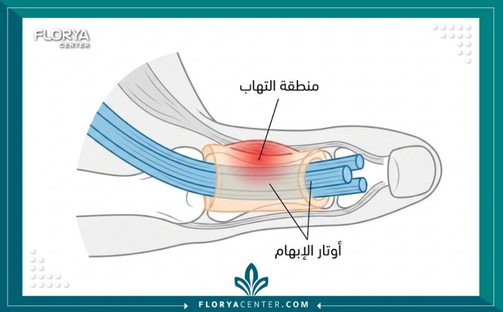 عملية علاج وتر الإبهام 1 - عملية علاج وتر الإبهام تُعتبر عملية علاج وتر الإبهام (Thumb Tendon Repair) حلاً جراحياً دقيقاً في فلوريا سنتر لاستعادة وظيفة اليد وتحرير الأوتار المتضررة بفعالية عالية جداً.