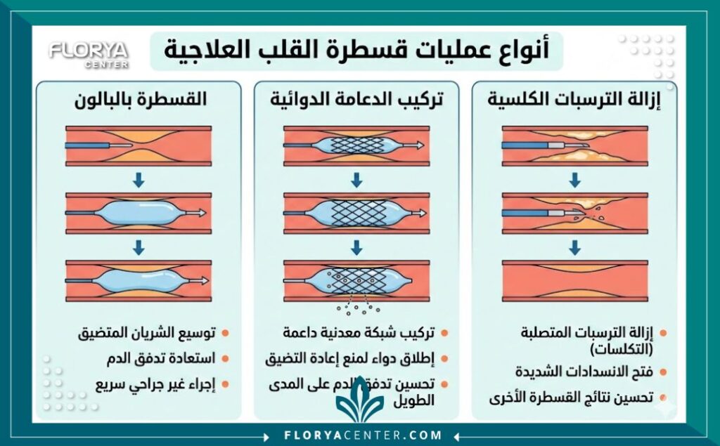 انفوجرافيك يوضح أنواع عملية قسطرة القلب العلاجية: توسيع بالبالون، وتركيب الدعامة الدوائية، وإزالة الترسبات الكلسية.