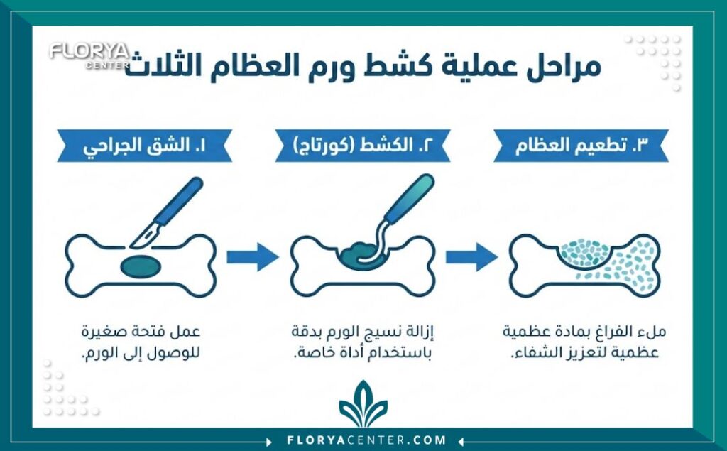 إنفوجرافيك يوضح مراحل عملية استئصال ورم عظمي حميد من التشخيص إلى كشط الورم وحشو الفراغ.