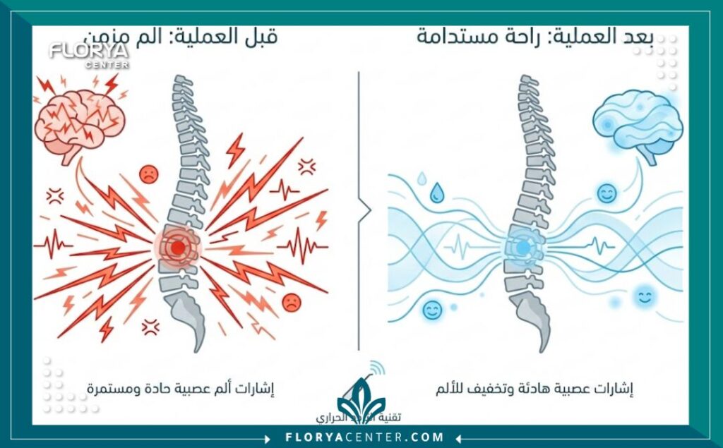 إنفوجرافيك يوضح نتائج عملية كي العصب بالتردد الحراري في تقليل إشارات الألم.