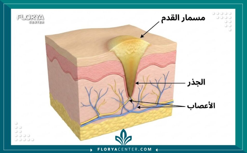 مخطط توضيحي لبنية مسمار القدم وجذره وتأثيره على الأعصاب قبل العملية.