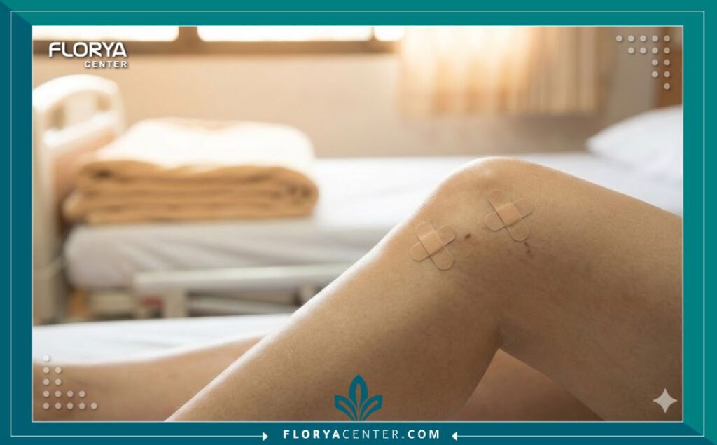 شكل الركبة بعد عملية المنظار التشخيصي يوضح صغر حجم الشقوق الجراحية وسرعة التئامها.