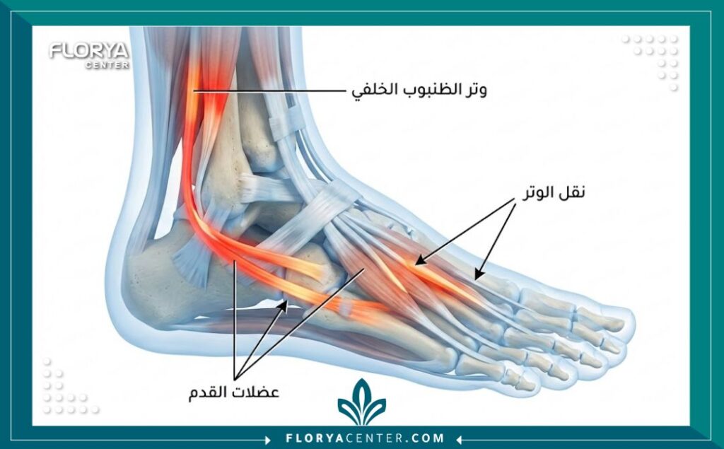 مخطط تشريحي يوضح أوتار القدم والعضلات المعنية في عملية نقل الأوتار لعلاج القدم المخلبية أو الفلات فوت.