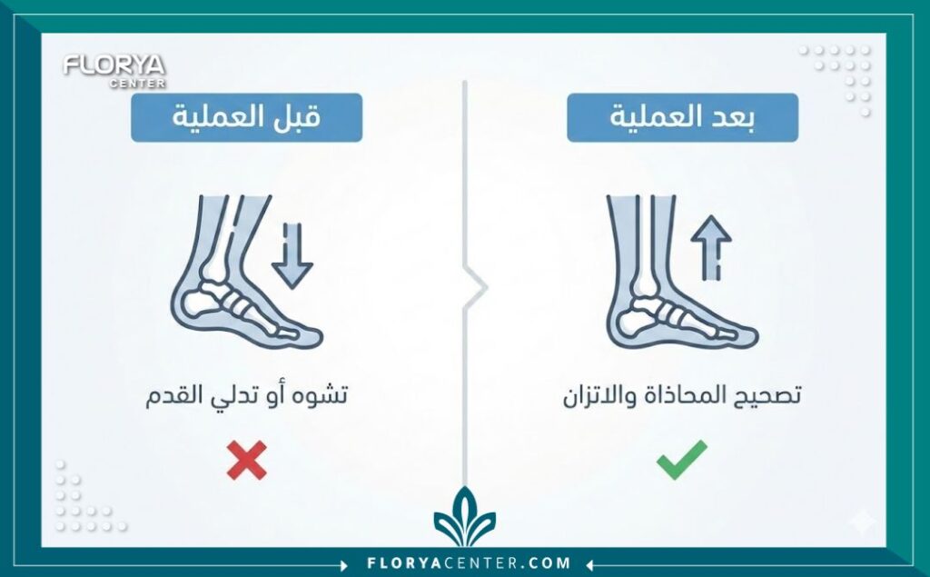  إنفوجرافيك يوضح نتائج عملية نقل أوتار القدم وتصحيح استقامة المشط والأنكل.