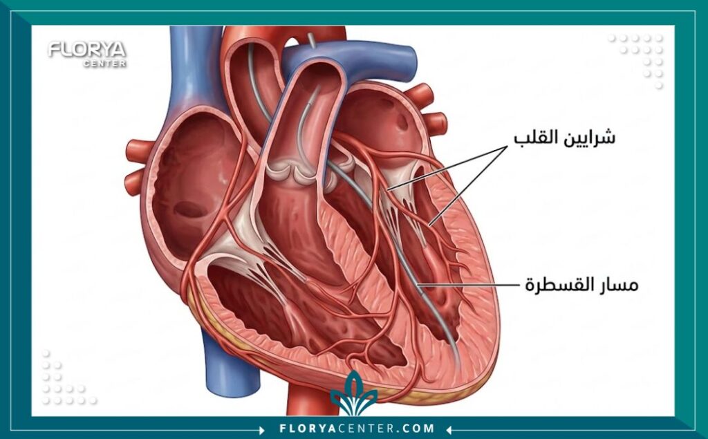 رسم تخطيطي طبي يوضح مسار أنبوب القسطرة داخل شرايين القلب.