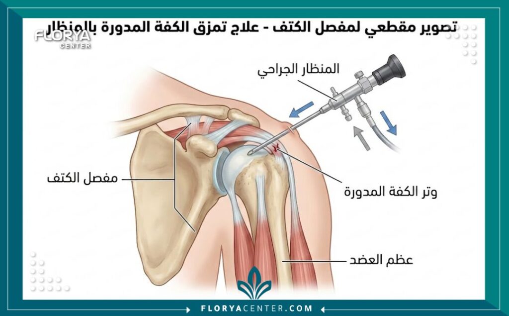 رسم توضيحي طبي يشرح كيفية دخول المنظار إلى مفصل الكتف لعلاج التمزقات.
