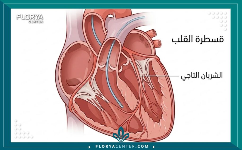 هل عملية القسطرة خطيرة؟ 2 رسم توضيحي طبي يشرح كيفية دخول أنبوب القسطرة إلى الشرايين التاجية في القلب.