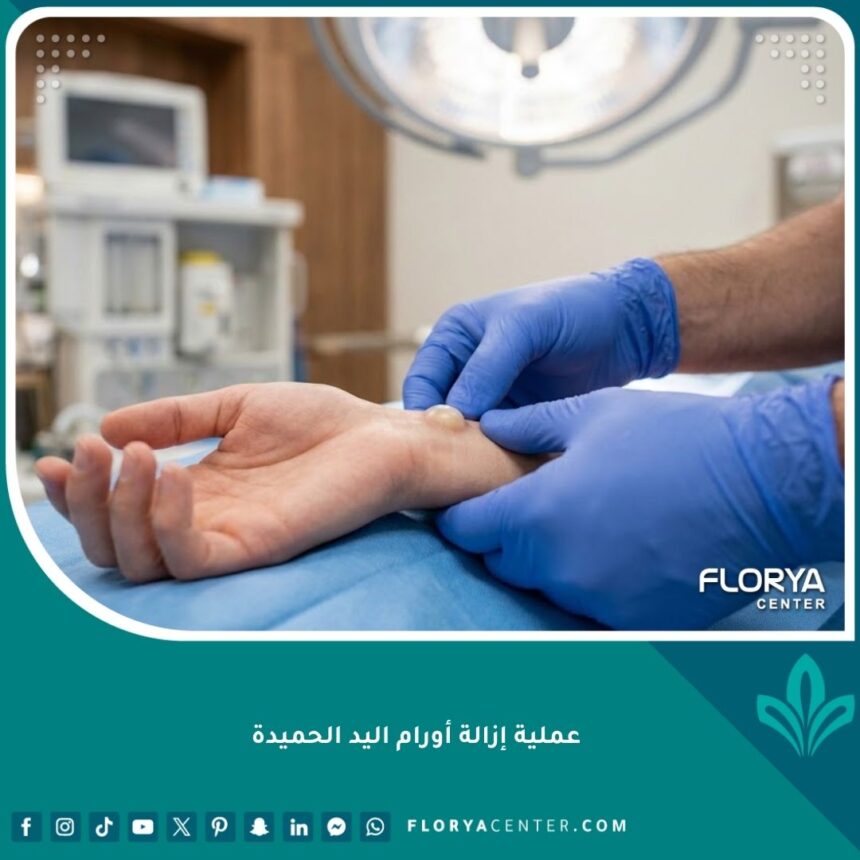 عملية إزالة أورام اليد الحميدة في عيادة تخصصية متطورة تظهر احترافية الجراح.