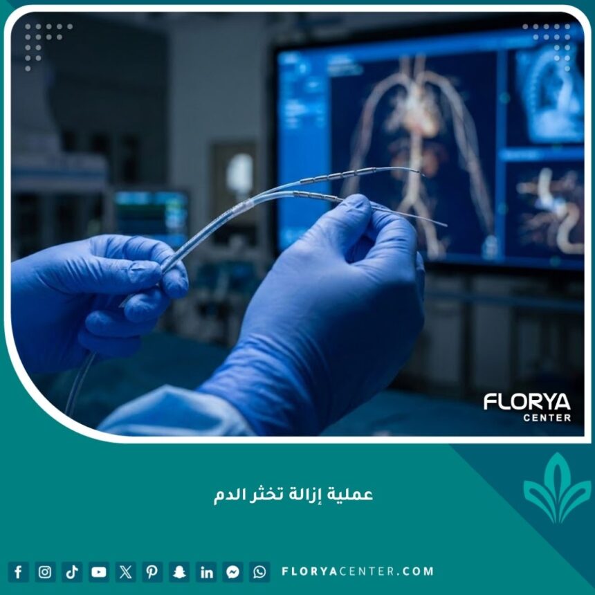 عملية إزالة تخثر الدم جراحياً باستخدام أحدث التقنيات الطبية في غرفة عمليات متطورة.