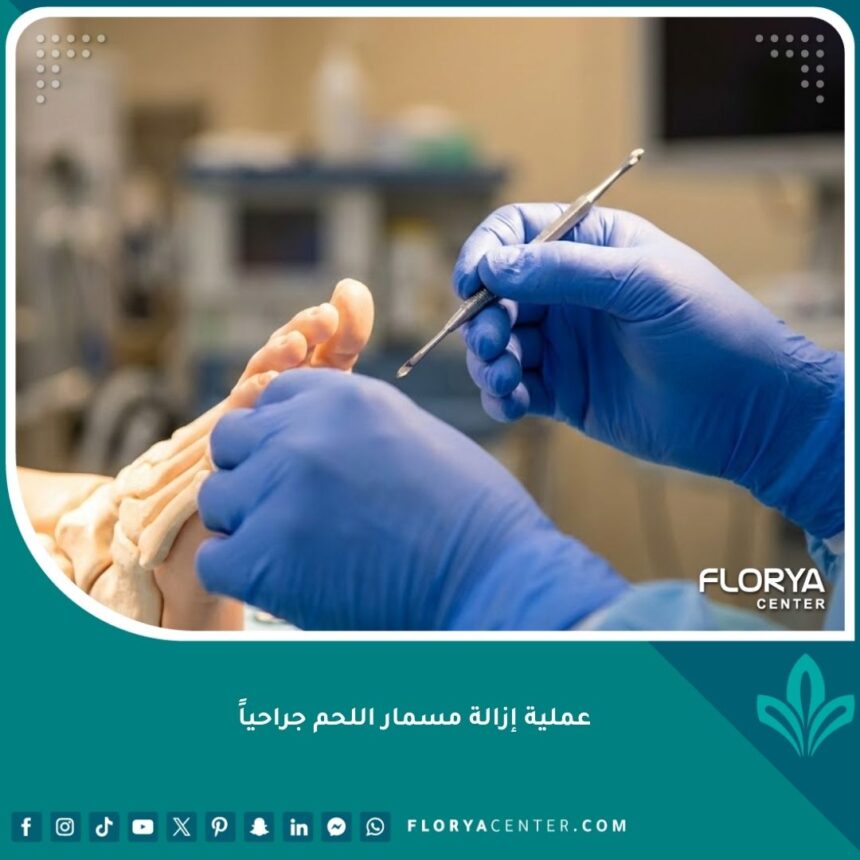 عملية إزالة مسمار اللحم جراحياً بأدوات طبية دقيقة في عيادة متخصصة.