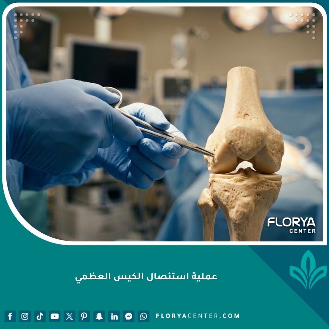 صورة احترافية تجسد عملية استئصال الكيس العظمي بدقة جراحية عالية في مركز عظام متخصص.