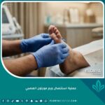 صورة احترافية لعملية فحص ورم مورتون العصبي في القدم قبل الاستئصال الجراحي.