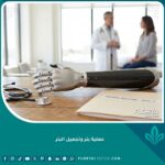 صورة واجهة تعبيرية عن عملية بتر وتجميل الأطراف تظهر طرفاً صناعياً حديثاً في عيادة طبية متطورة.