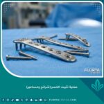 صورة احترافية للشرائح والمسامير الطبية المستخدمة في عمليات تثبيت كسور العظام بدقة عالية.