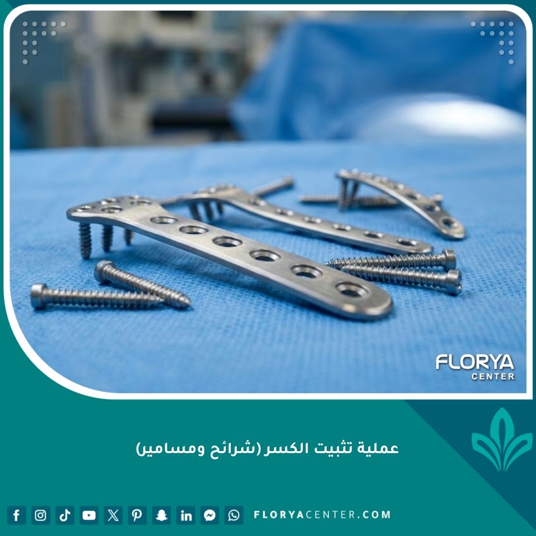 صورة احترافية للشرائح والمسامير الطبية المستخدمة في عمليات تثبيت كسور العظام بدقة عالية.