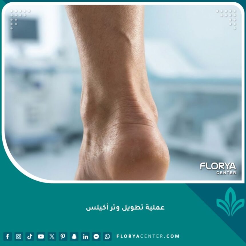صورة احترافية توضح منطقة وتر أكيلس في الكاحل تمهيداً لعملية التطويل الجراحية.