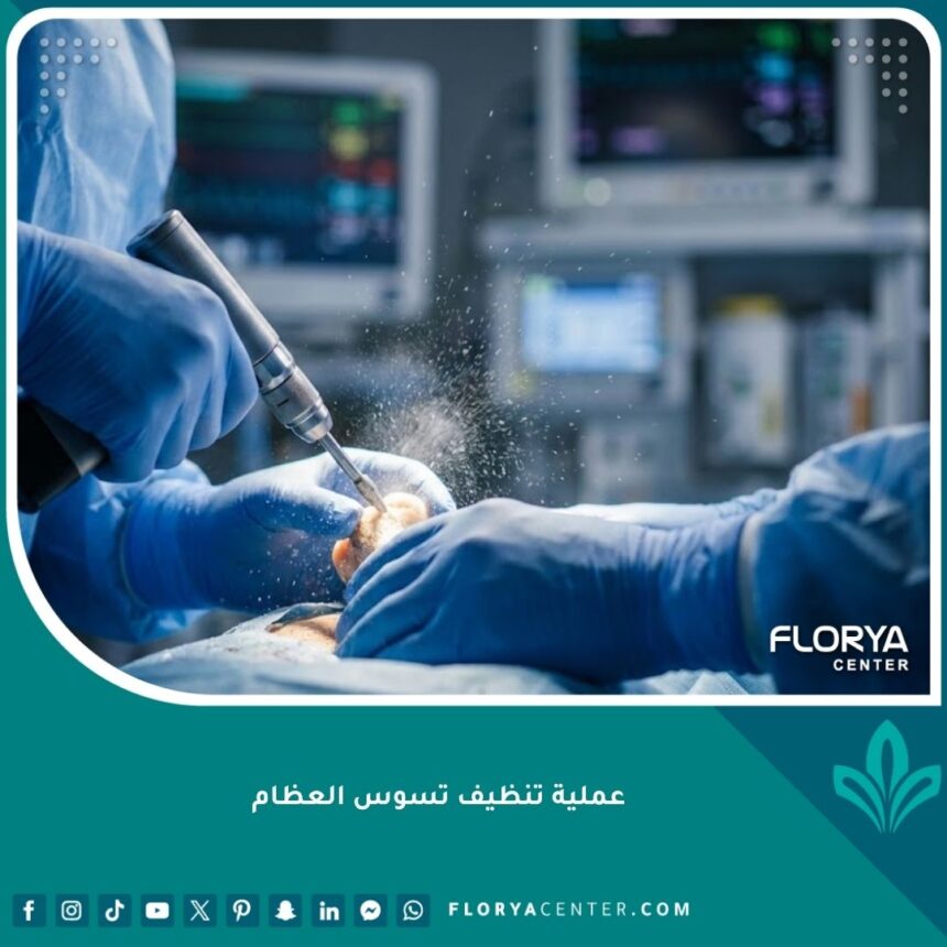 صورة احترافية عالية الدقة تظهر جراح عظام مختص يقوم بعملية دقيقة لتنظيف تسوس ونخر العظام باستخدام أدوات طبية متطورة داخل غرفة عمليات معقمة.