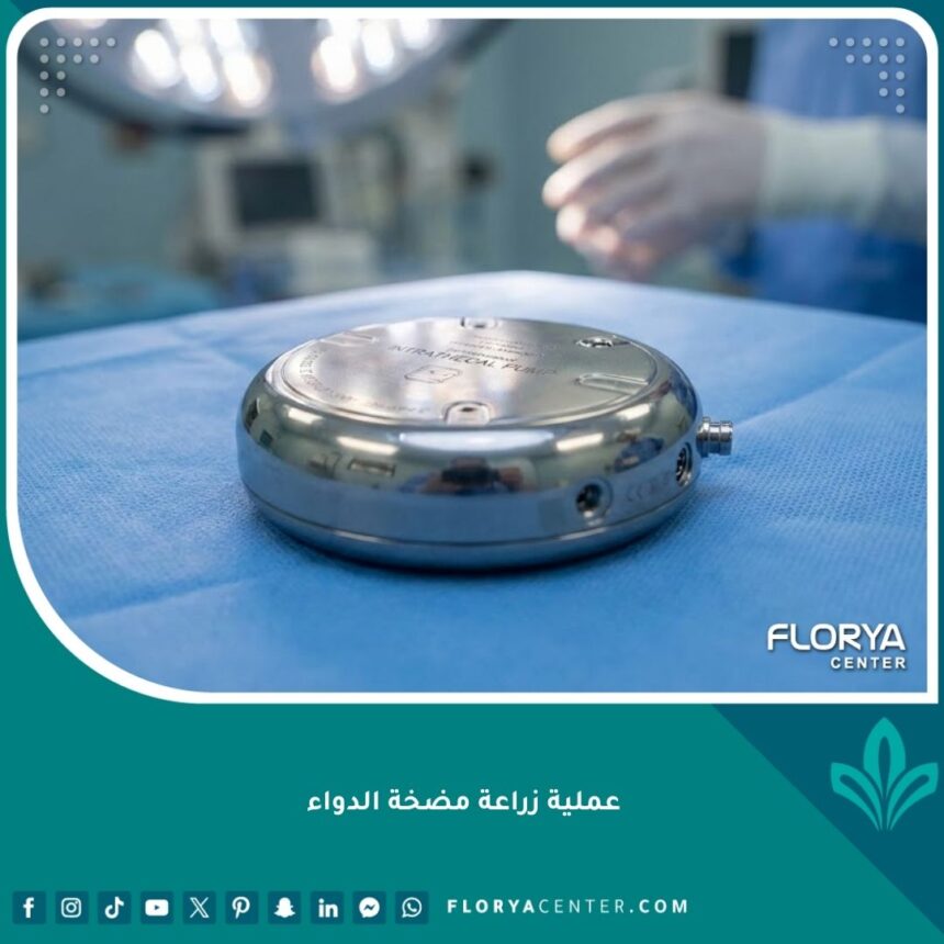 جهاز مضخة الدواء المبرمجة لزراعة العمود الفقري في بيئة طبية معقمة.