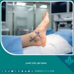 صورة احترافية لعملية نقل أوتار القدم تظهر دقة التخطيط الجراحي في مركز طبي متخصص.