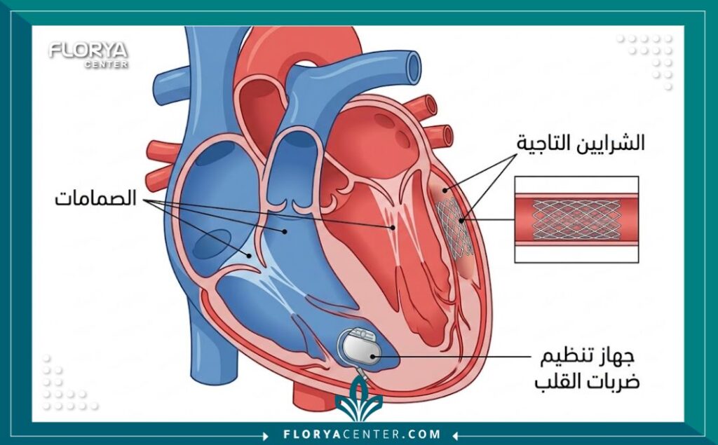 مخطط توضيحي طبي يشرح تشريح القلب وأماكن تركيب الدعامات ومنظم ضربات القلب.