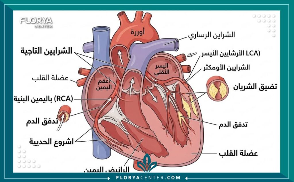 مخطط توضيحي طبي لتشريح القلب يظهر الشرايين التاجية مع تضيق ناتج عن تراكم اللويحات، مع تسميات عربية تشرح الأجزاء وعملية انسداد تدفق الدم.