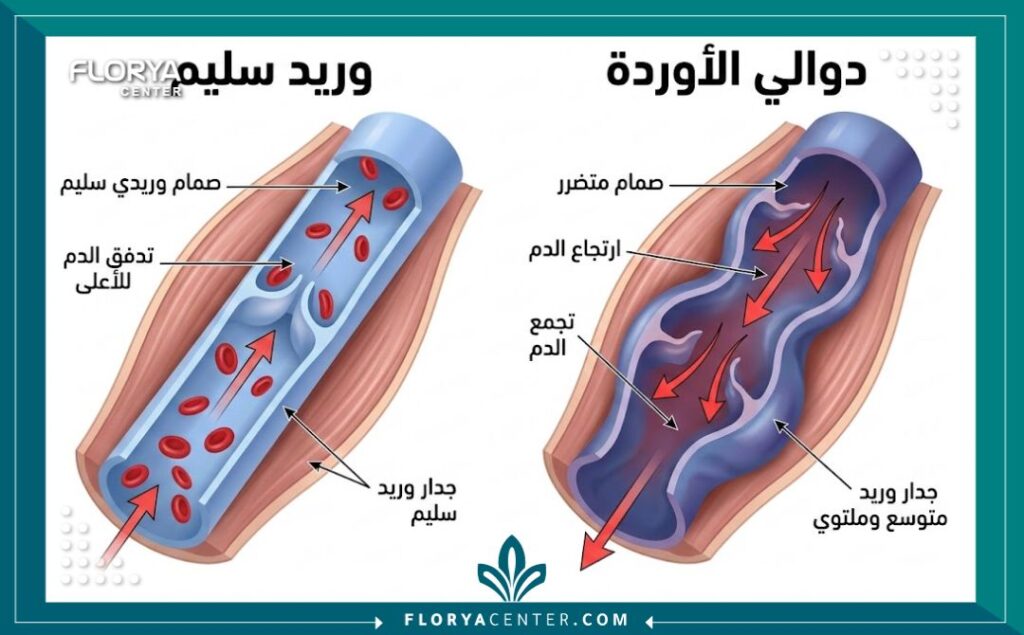 مخطط طبي يوضح الفرق بين الأوردة السليمة ودوالي الساقين مع تسميات توضيحية باللغة العربية.