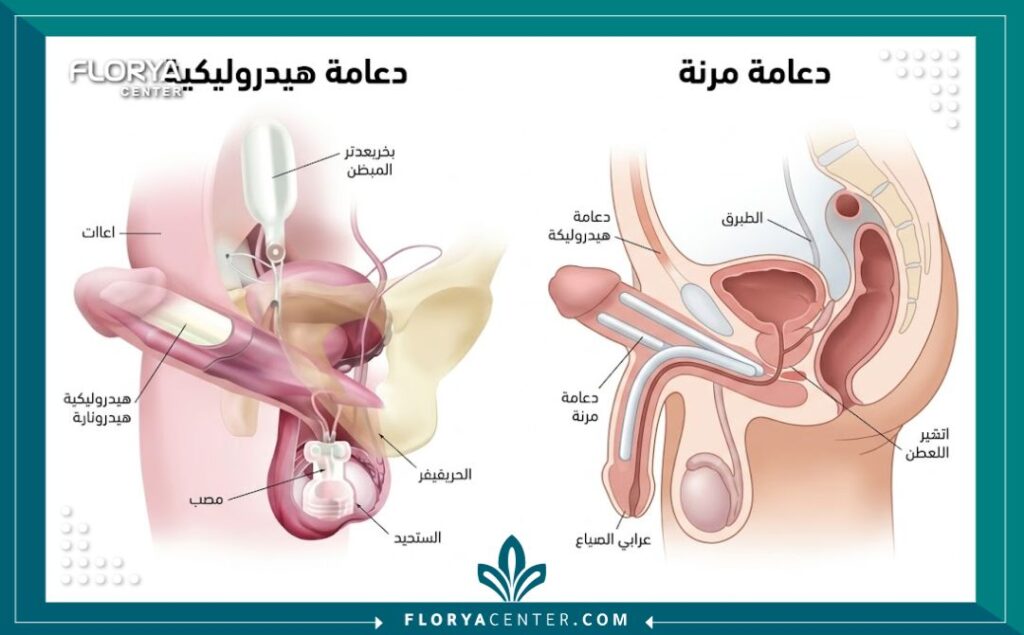 مخطط طبي توضيحي يوضح أماكن تركيب دعامة العضو الذكري المرنة والهيدروليكية.