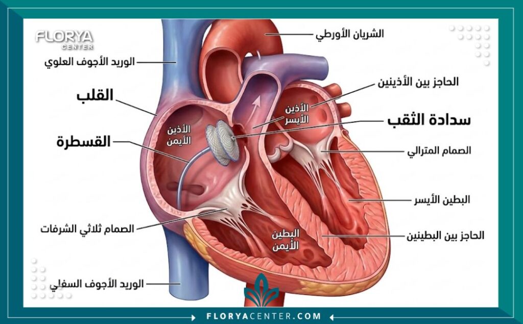 مخطط طبي يوضح كيفية إغلاق ثقب القلب باستخدام جهاز السدادة عبر القسطرة للأطفال.