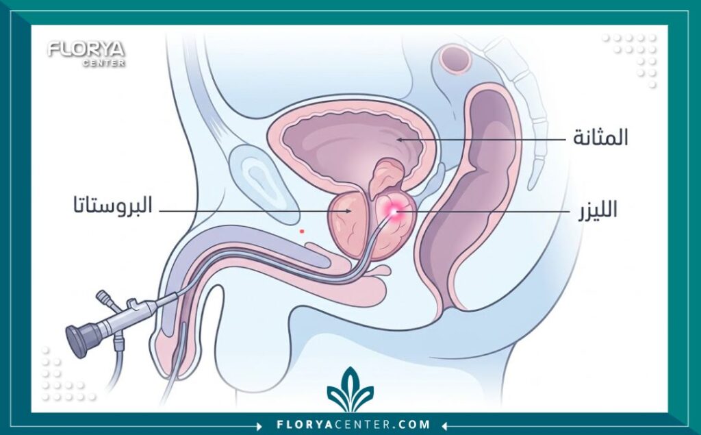 مخطط توضيحي لعملية تبخير البروستاتا بالليزر وكيفية إزالة الأنسجة المتضخمة.