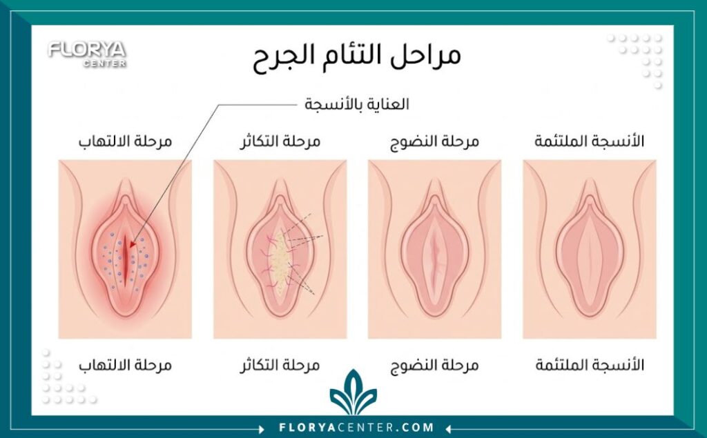 رسم تخطيطي طبي يوضح الفرق في التأثير على الأنسجة بين ليزر المهبل والجراحة التقليدية.