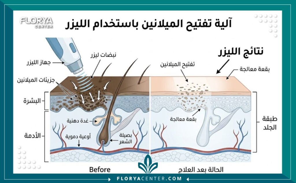مخطط طبي يوضح عملية تفتيح طبقات الجلد وتقليل تصبغات الميلانين في المناطق الحساسة.
