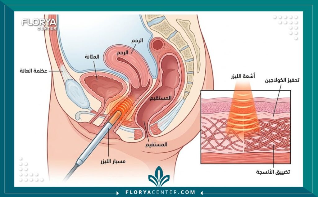 رسم توضيحي طبي يشرح آلية تضييق المهبل بالليزر وتحفيز الكولاجين بدون جراحة.