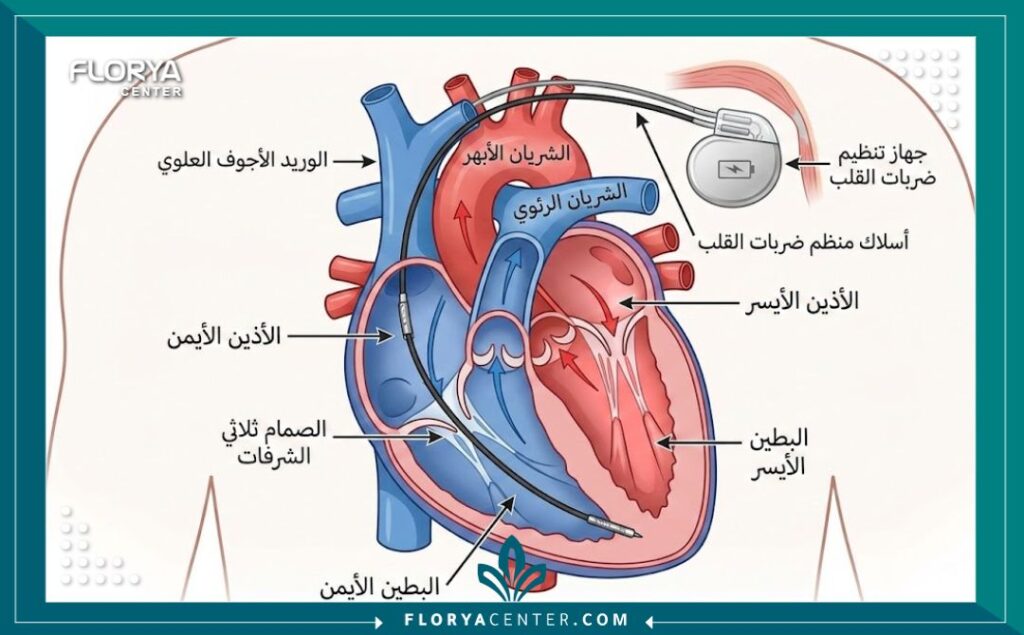 رسم تخطيطي طبي يوضح أماكن وضع أسلاك جهاز تنظيم ضربات القلب ثنائي الغرف داخل القلب.