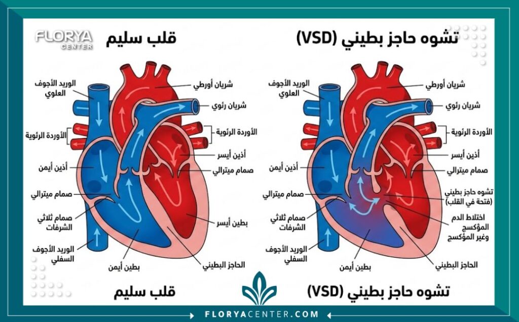 رسم تخطيطي طبي يوضح الفرق بين القلب السليم وتشوه الحاجز البطيني عند الجنين وكيفية تشخيصه.