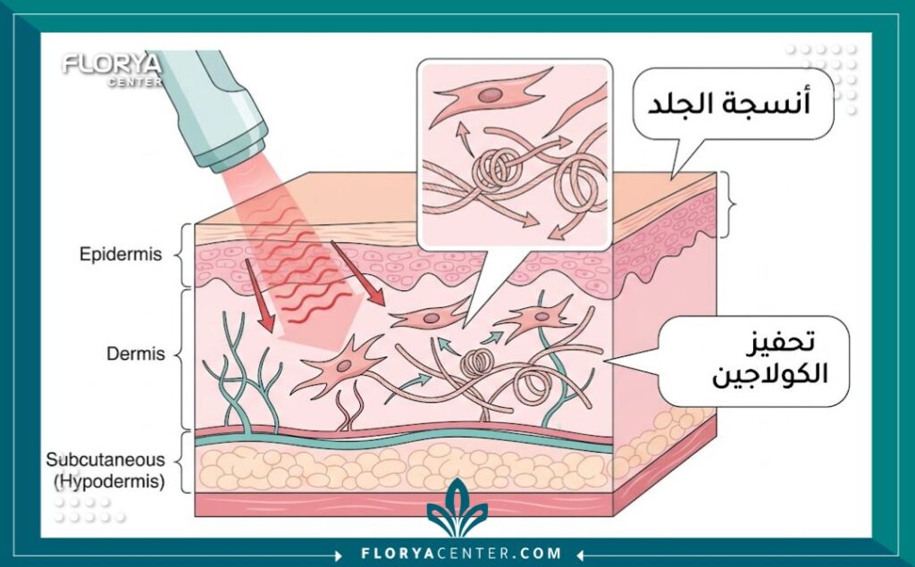 رسم توضيحي طبي يشرح كيفية عمل الليزر في تحفيز الكولاجين لشد وتصغير الشفرات.
