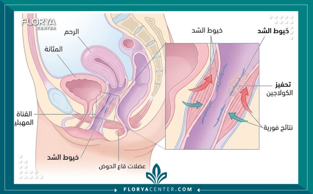 مخطط توضيحي طبي لكيفية عمل خيوط تضييق المهبل وتحفيز الأنسجة.