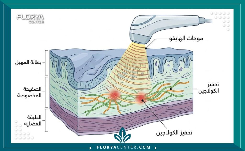 رسم تخطيطي طبي يوضح تأثير موجات الهايفو على أنسجة المهبل لزيادة المرونة.