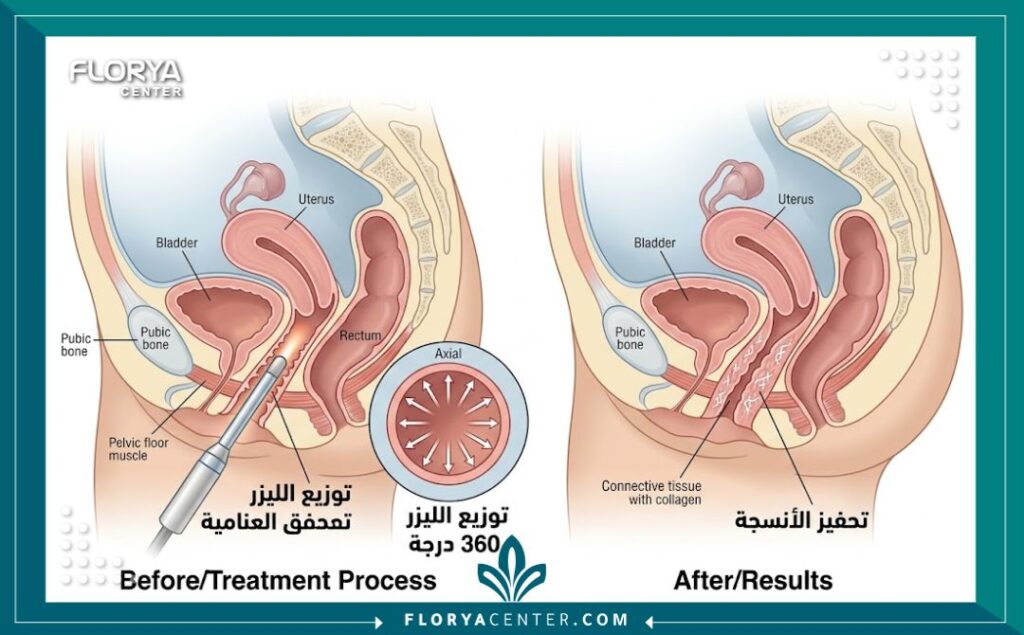 رسم تخطيطي طبي يوضح آلية عمل تقنية تضييق المهبل 360 درجة.