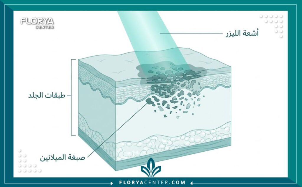 مخطط طبي يوضح آلية عمل أشعة الليزر في تفتيح تصبغات الجلد والمناطق الحساسة.