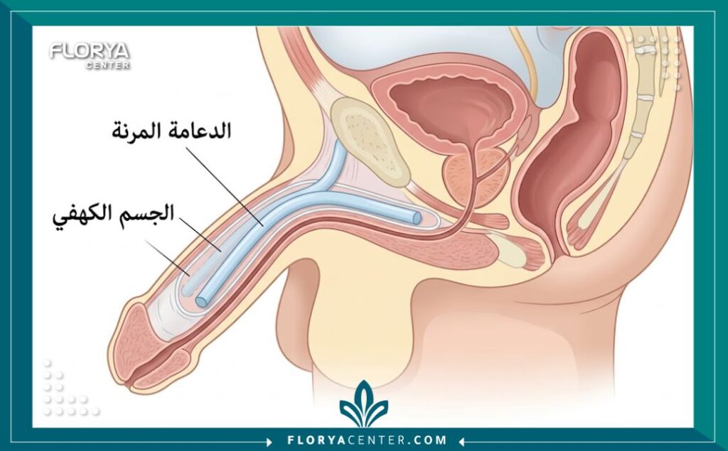 مخطط طبي توضيحي يبيّن كيفية تركيب الدعامة المرنة داخل الجسم بدقة.