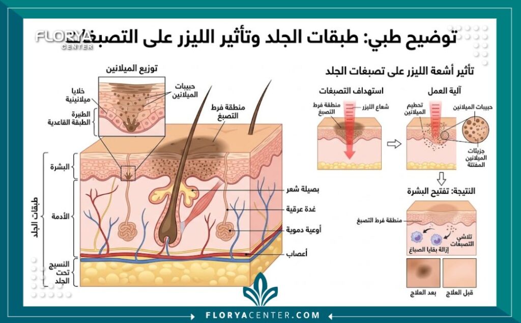 رسم توضيحي طبي لطبقات الجلد وكيفية تأثير الليزر في تفتيح التصبغات في المناطق الحساسة.