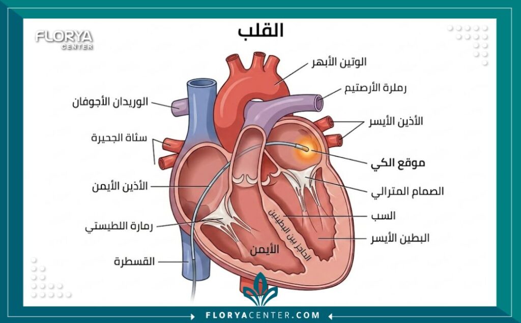 تكلفة عملية كي القلب 2 مخطط طبي تشريحي يوضح كيفية إدخال القسطرة وموقع الكي داخل غرف القلب لعلاج الارتجاف الأذيني.
