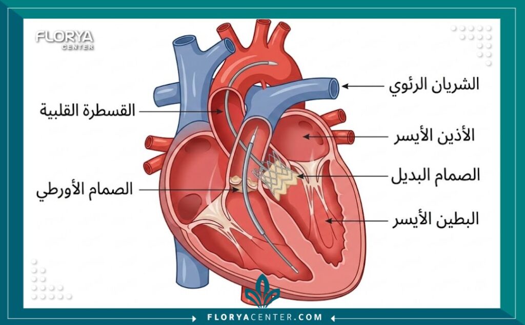 رسم تخطيطي يوضح كيفية استبدال الصمام الأورطي عبر القسطرة (TAVI).