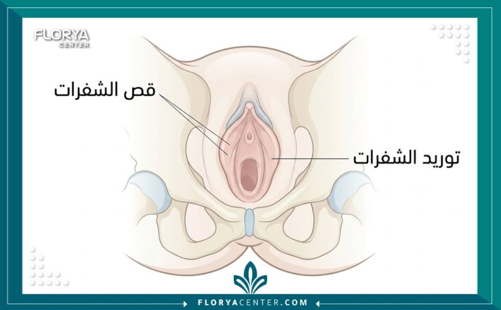 رسم تخطيطي طبي يوضح المناطق المستهدفة في عملية قص وتجميل الشفرات.