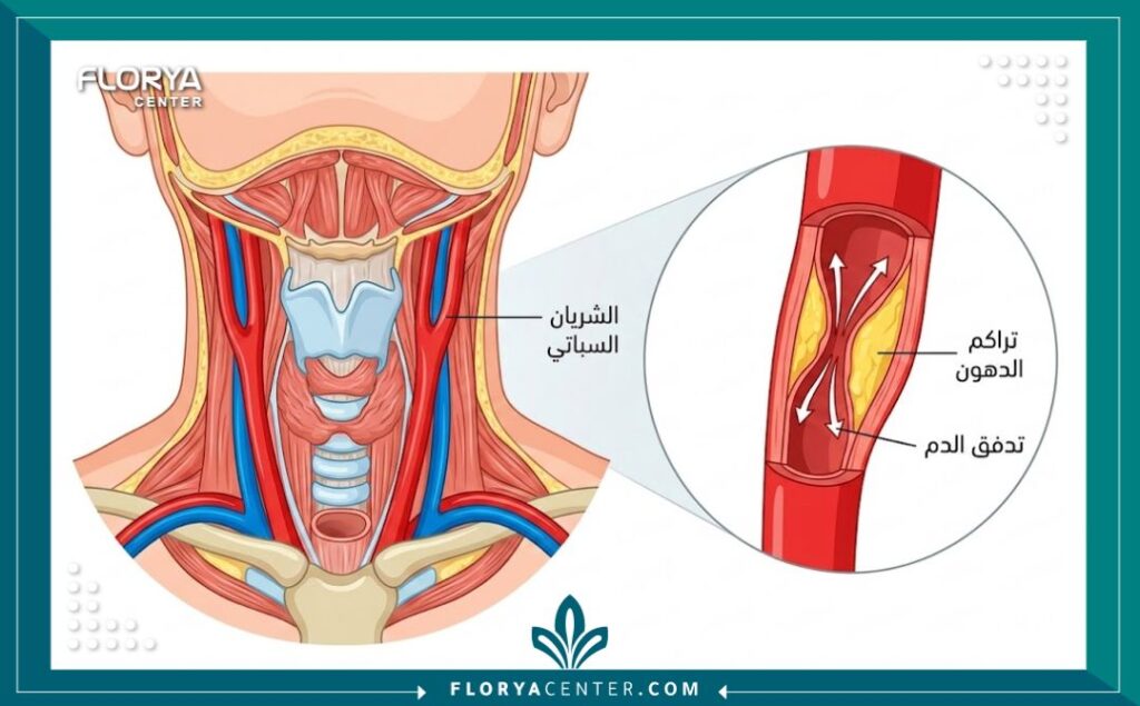 رسم تخطيطي طبي يوضح تشريح الشريان السباتي وانسداده وتراكم اللويحات الدهنية.