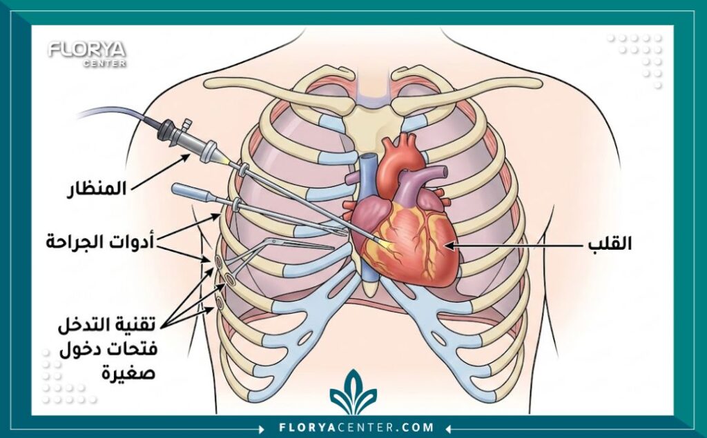 رسم بياني طبي يوضح تشريح الصدر ومسارات دخول أدوات جراحة القلب بالمنظار في تقنية التدخل الجراحي المحدود، مع تسميات دقيقة باللغة العربية.