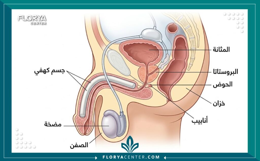 مخطط طبي تشريحي يوضح كيفية زراعة الدعامة الهيدروليكية القابلة للنفخ في الجسم الكهفي للعضو الذكري، مع تصنيفات بالعربية.